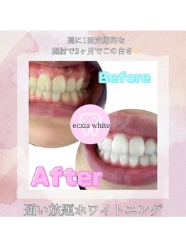 エクシアホワイトニング 明石店/ビフォーアフター