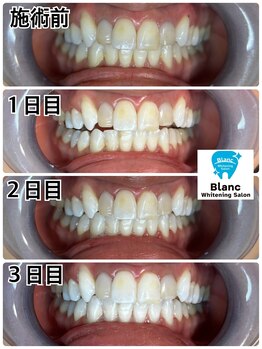 ブラン 心斎橋店(Blanc)/ダラダラとしたホワイトニングNO