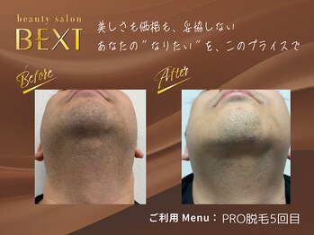 ベクスト(BEXT)/ヒゲ脱毛(PRO)