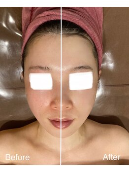 ハナ トータル ケア(Hana Total Care)/ベビースキン水玉リフティング