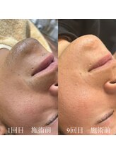 ランプ(LAMP)/～ハイブリッドヒゲ脱毛～