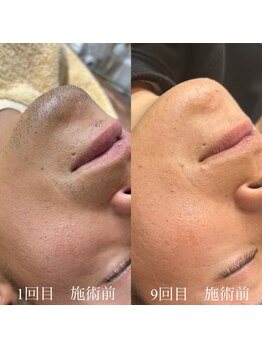 ランプ(LAMP)/~ハイブリッドヒゲ脱毛~