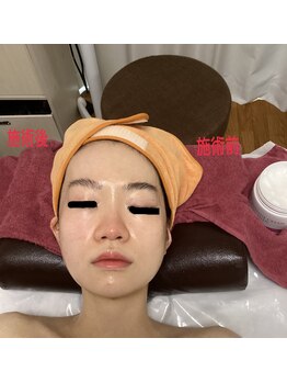 ミュー 新小岩店(Mieux)/オールハンド小顔コルギ施術前後