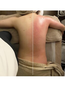 エニ 恵比寿(eni)/背中のビフォーアフター