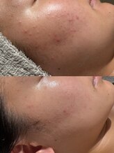 ウルソワン 都島店(/ulu soin)/ニキビ改善2回