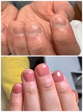 ウェルネスマルカ(wellness MARCA)/深爪矯正