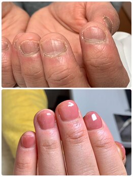 ウェルネスマルカ(wellness MARCA)/深爪矯正