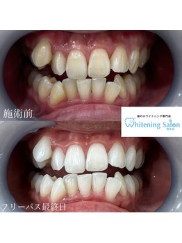 ホワイトニングサロン 熊本店/今から遅くない！ホワイトニング