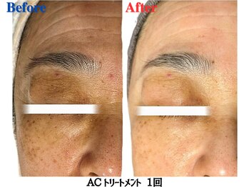 マリス(MARISS)/ACトリートメント<シミシワ改善>