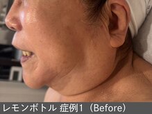 オアシスラグーン(OASIS LAGOON)/レモンボトル（症例1 before）