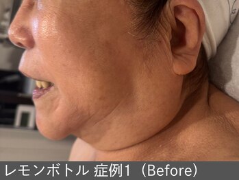 オアシスラグーン(OASIS LAGOON)/レモンボトル(症例1 before)