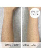 ココスターリー 香椎店(Coco starry)/男性・照射1回☆1ヶ月後