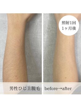 ココスターリー 香椎店(Coco starry)/男性・照射1回☆1ヶ月後