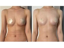 モア(moa)/ミラクルバスト