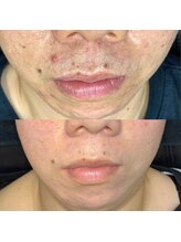 アーフ(ARF)/肌質改善