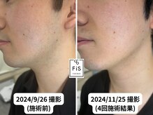 フィズ 多摩センター店(FIS)/☆脱毛途中経過［多摩センター］