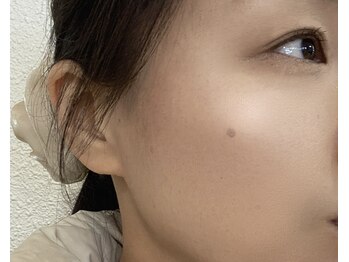 バーテックスキー(Vertexkey)/耳のマッサージで小顔に