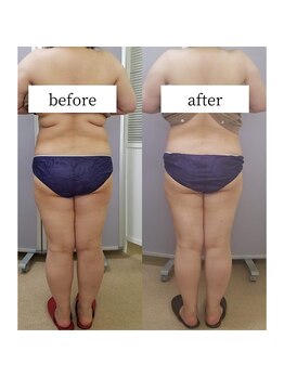 アップルミント/＜痩身＞before・after