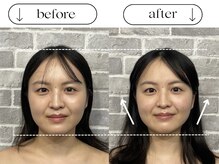 ビースタイル(B-style)/【電気美容鍼】ビフォーアフター