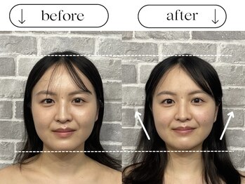 ビースタイル(B-style)/【電気美容鍼】ビフォーアフター