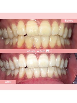 エクシアホワイトニング 札幌琴似店/ホワイトニングビフォーアフター