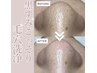 【毛穴洗浄/黒ずみ】毛穴エクストラクションコース¥12000→¥8500