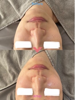 アレイズ(ARAYS)/症例(小顔矯正)