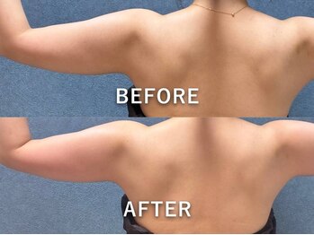 ビーホープ(B.hope)/30代モニター様2回目