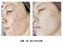 ハーバリー ハーブピーリング 岐阜(HERBERRYハーブピーリング)/ハーブピーリング専門店HERBERRY