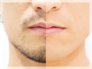 オークツリー(oak tree)/☆魅せる髭脱毛☆