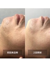 リムル(REMURU)/ひげ脱毛2回照射