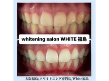 ホワイトニングサロン ホワイト(WHITE)/セルフホワイトニング/大阪/福島
