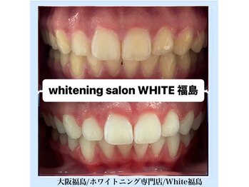 ホワイトニングサロン ホワイト(WHITE)/セルフホワイトニング/大阪/福島