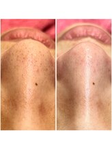 リンク(LiNK)/韓国式3D毛穴洗浄