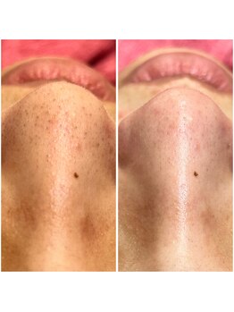 リンク(LiNK)/韓国式3D毛穴洗浄