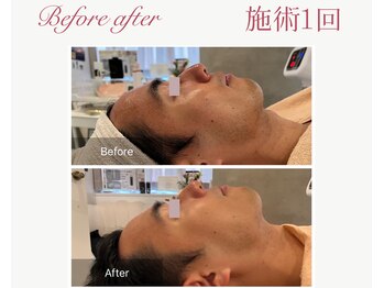 パルタージュ 三宮(Partage)/ハーブトリートメント