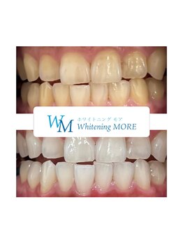 ホワイトニング モア(Whitening MORE)/ビフォーアフター