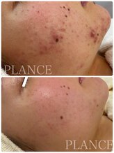 プランス 恵比寿店(PLANCE)/頑固なしこりニキビも改善