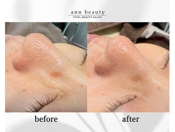アン ビューティー(ann beauty)/施術後1回【症例写真】50代
