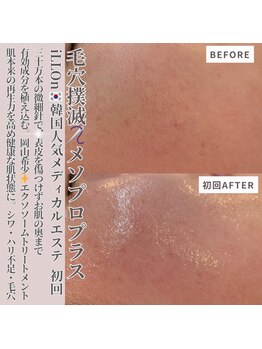 クラルテアンドコー(Salon Clarte&Co.)/毛穴撲滅◎特許成分メソプロ+
