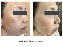 ハーバリー ハーブピーリング 岐阜(HERBERRYハーブピーリング)/ハーブピーリング専門店HERBERRY