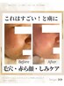 【モニター価格】全顔シミケアあて放題＋ヘッドマッサージ付¥16500→¥11000