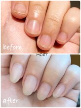 モストネイル 五日市店(MOST nail)/深爪補正ケア