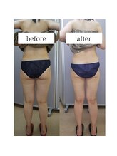 アップルミント/＜痩身＞before・after