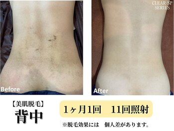 ベルホワイト(Belle White)/【美肌脱毛／背中】