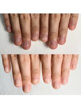 イズム(Izm)/爪噛み、むしり改善