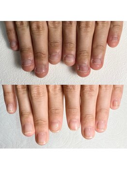 イズム(Izm)/爪噛み、むしり改善