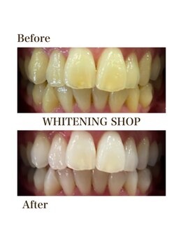 ホワイトニングショップ 徳島藍住店/Before After美白ホワイトニング