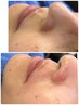 【産毛・毛穴・くすみ改善】フェイシャルWax×LED脱毛90分