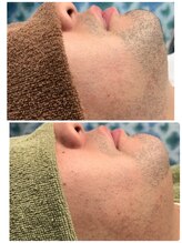 ビューティーアンドボディメイクBB シャオ西尾店/メンズ・ヒゲ脱毛☆